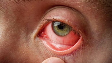 Photo of Conjunctivitis से इस तरह करें बचाव….