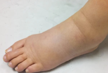 Photo of पैरों में सूजन की समस्या से निजात पाने के लिए अपनाए ये  घरेलू उपचार