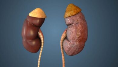 Photo of क्या किडनी स्टोन के मरीजों को तला-भुना खाना चाहिए