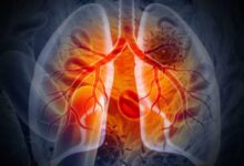 Photo of फेफड़ों के कैंसर के खिलाफ बड़ी कामयाबी! जाने केसे