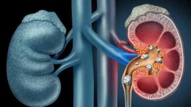 Photo of किडनी स्टोन वापस आने से कैसे रोकें?